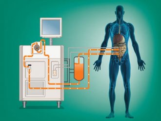 Sitoredüktif Cerrahi + Hipertermik İntraperitoneal Kemoterapi (HIPEK)