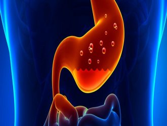 Hiatal Hernia and Gastroesophageal Reflux