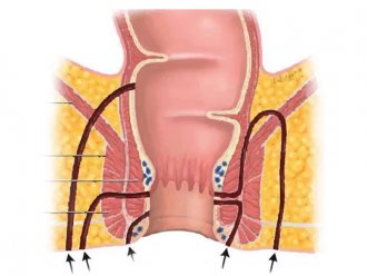 Anal Fistula